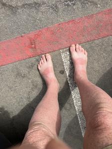 image SunburnFeet26.jpg 